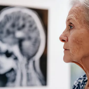 Symbolbild zum GÖG-Kurzbericht: Ältere Frau vor Gehirnscan – Fokus auf Alzheimer-Demenz, Versorgung und neue Antikörpertherapien.